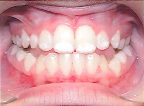 Nidel Law Re-files Case For Injury From Fluoridated Drinking Water